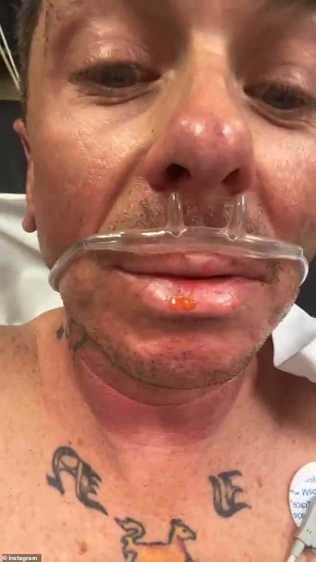 وقال إن ألسنة اللهب أحرقت شاربه حتى، كما مازح حول كيفية اتخاذه القرار في النهاية بحلقه قبل ركوب السيارة والذهاب إلى المستشفى.