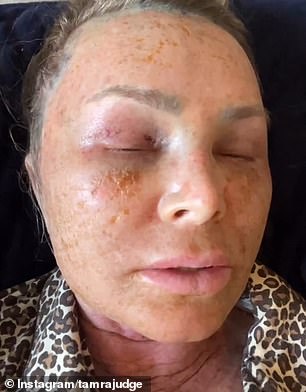 عانى الرجل البالغ من العمر 57 عامًا من التورم الشديد والألم منذ إجراء العملية.