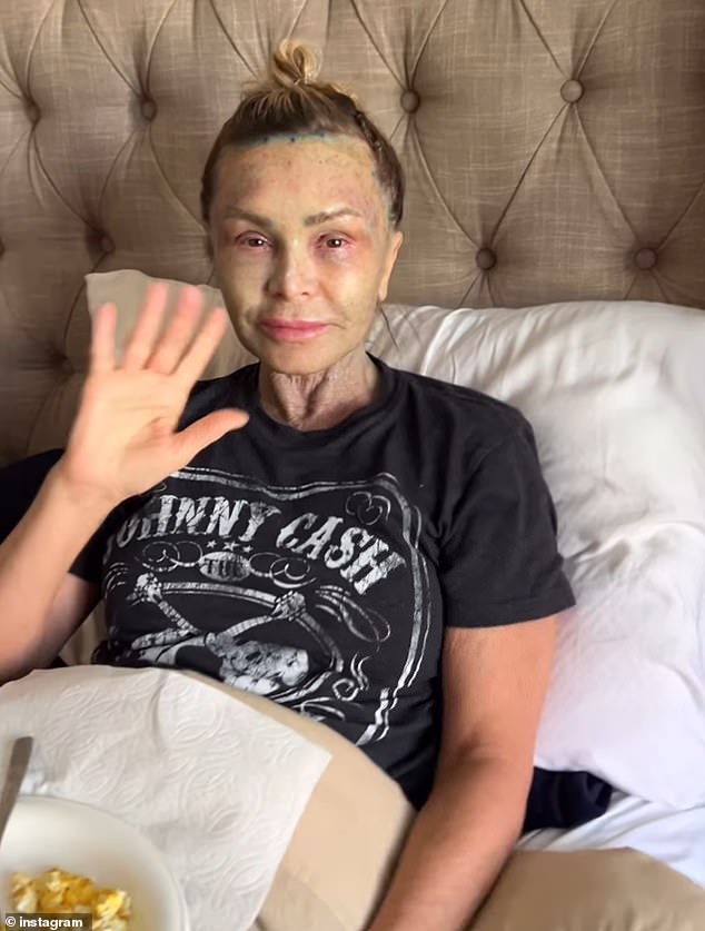 قضت نجمة تلفزيون الواقع، التي أنفقت أموالاً طائلة على عملية التجميل الجراحية كهدية عيد ميلادها السابع والخمسين، أيامًا في الفراش للتعافي من الإجراءات