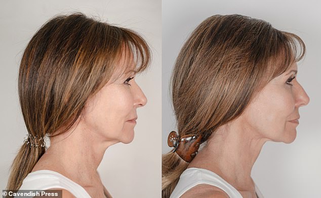 خضعت للعلاج ببلازما النيتروجين لمدة ستة أشهر، مما أدى إلى تحفيز الكولاجين في وجهها ورقبتها (يسارًا، قبل، ويمينًا، بعد).