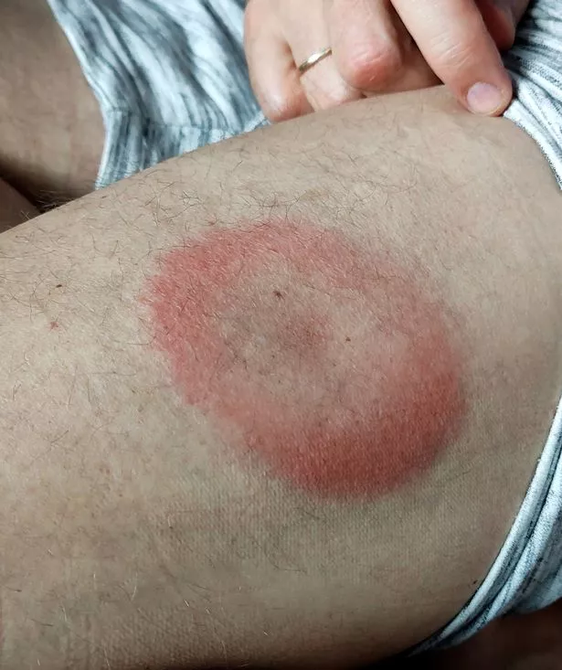 عادة ما يكون مرض لايم قابل للعلاج بالمضادات الحيوية