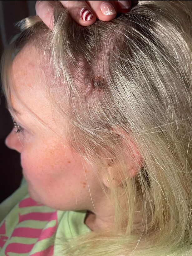 الخلد بحجم 10p على فروة رأس ميكايلا