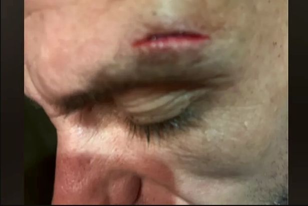 كيران مع غاش على رأسه فوق حاجبه