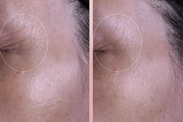 قبل وبعد استخدام كريمة الماء المتكرر للبشرة السريعة Retinol + HPR