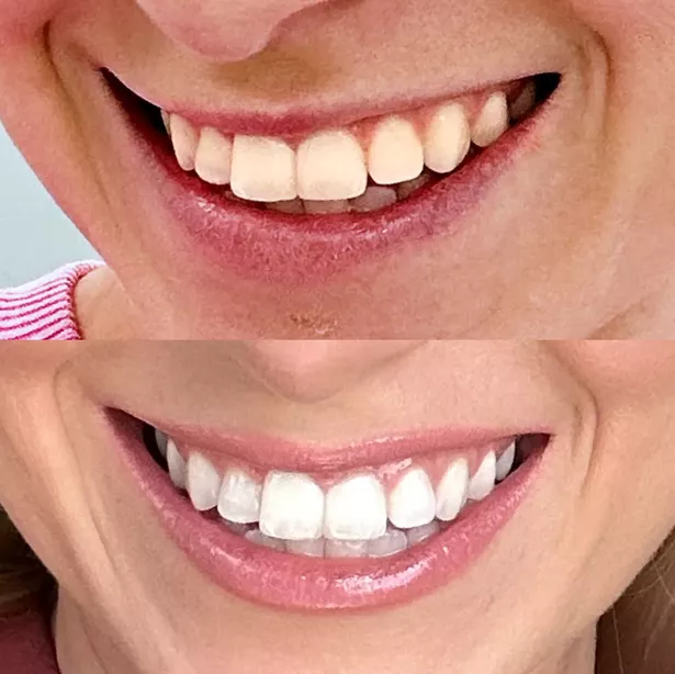 قبل وبعد من استخدام منتجات mysweetsmile