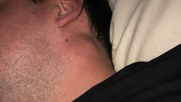 تم تشخيص كتلة ستو على أنها سرطان الجلد النادر