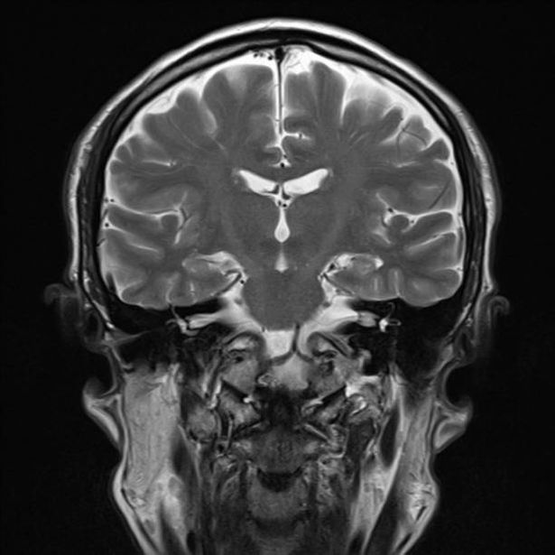 فحص التصوير بالرنين المغناطيسي التاجي (MRI) للدماغ البشري الطبيعي