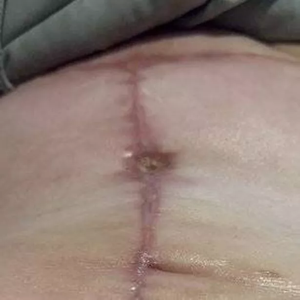 Chantelle Woolston - Tummy Tuck Post Op Photo 