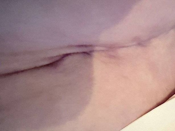 Chantelle Woolston - Post Surgery Tummy Tuck Pic