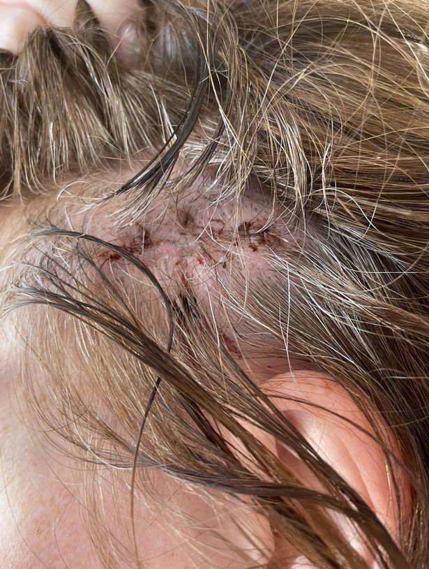 فروة رأس ميكايلا بعد إزالة الخلد