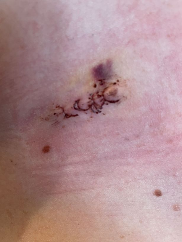 معدة ميكايلا بعد إزالة الشامات