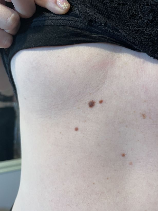 الشامات على معدة ميكايلا التي تمت إزالتها منذ ذلك الحين