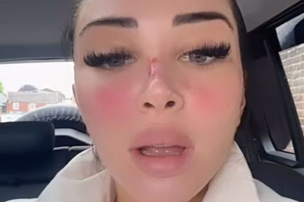 تكشف Tulisa أنفًا مؤلمًا بالدماء بعد خضوعه لستة علاجات تجميل