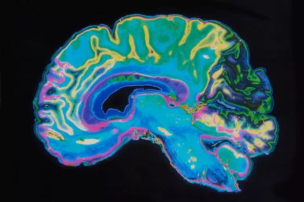 MRI صورة الدماغ على خلفية سوداء