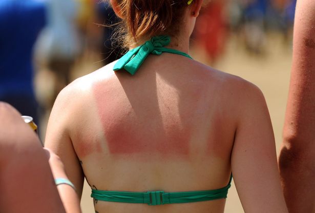 يمكن أن يكون Sunburn مشكلة حقيقية في نهاية هذا الأسبوع حيث أن Brtis يستلقي في أشعة الشمس