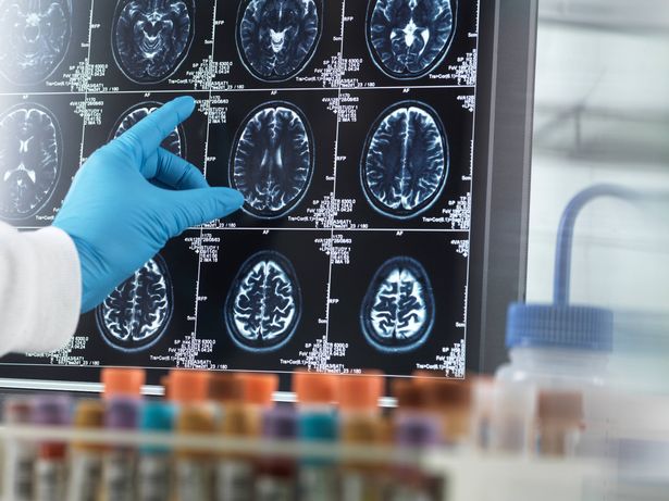 الصورة المفاهيمية للبحث السريري لتطوير علاج محتمل لمرض الزهايمر والخرف