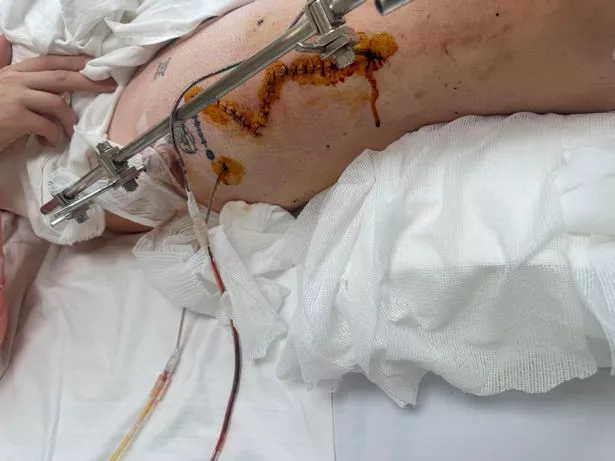 لقد طلب جراحة لإنقاذ الحياة في تايلاند بعد ساعات فقط من السقوط
