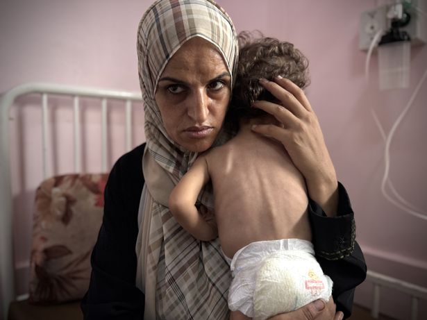 يتلقى الأطفال الفلسطينيون الذين يعانون من سوء التغذية علاجًا طبيًا محدودًا بسبب نقص حرك الأطفال والطب في مستشفى ناصر في خان يونيس