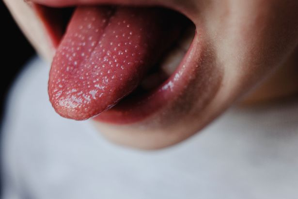 يمكن أن يبدو أن اللسان يحتوي على نتوءات وأحمر ، مما يؤدي إلى ما يعرف باسم 