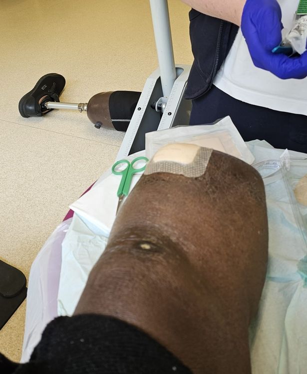 Olubiyi Jibowu في المستشفى بعد بتر ساقه (مطبعة المربى)