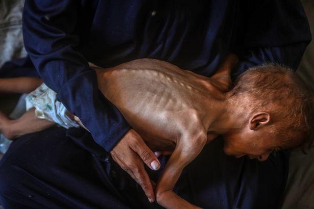 طفل صغير محمد زكريا أيوب آل ماتيك يتضورون جوعا في غزة
