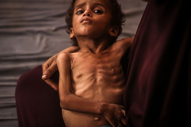   شوهد يوزن أبو فول ، البالغ من العمر عامين ، الذي تدهورت صحته بسبب نقص الوصول إلى الغذاء والمكملات الغذائية ، مع والدته في معسكر اللاجئين في شاتي في قطاع غزة في 24 يوليو 2025. العيش في ظل ظروف قاسية في معسكر اللاجئين في شاتي في مدينة غازا الغربية ، أصدرت عائلة أبو فول نداءً للمساعدة لطفلهم المتعثر