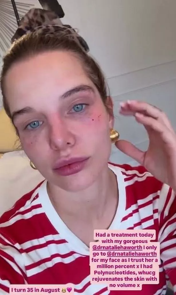 خضعت هيلين لجراحة تجميلية