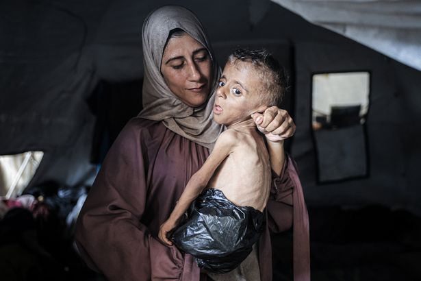 فتى سوء التغذية ووالدته