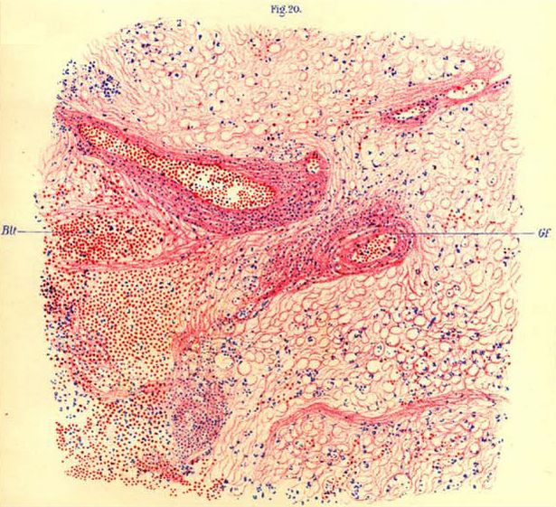 Corpus striatum من قرد مصاب (الهيماتوكسيلين-إيوسين ، × 128). الاختصارات: BLT ، نزيف حول الأوعية. GF ، السفينة المتسللة