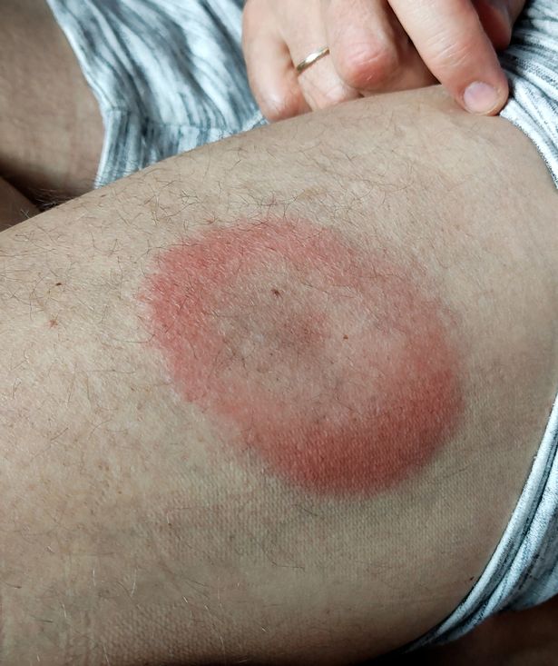عادة ما يكون مرض لايم قابل للعلاج بالمضادات الحيوية