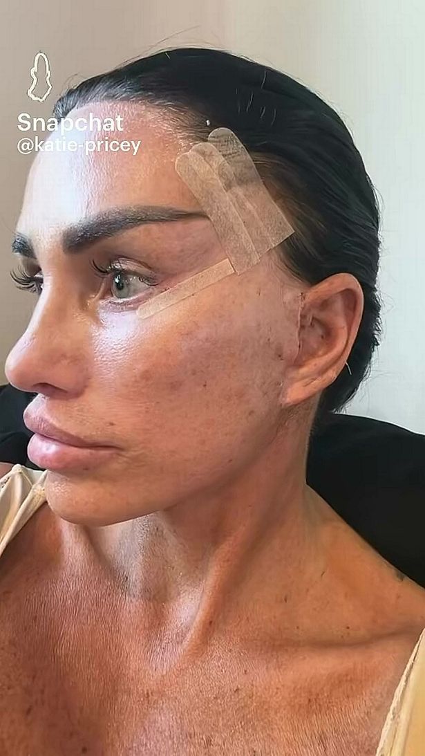 يعرض كاتي برايس نتائج جراحة تجميل الوجه السابقة في الضمادات