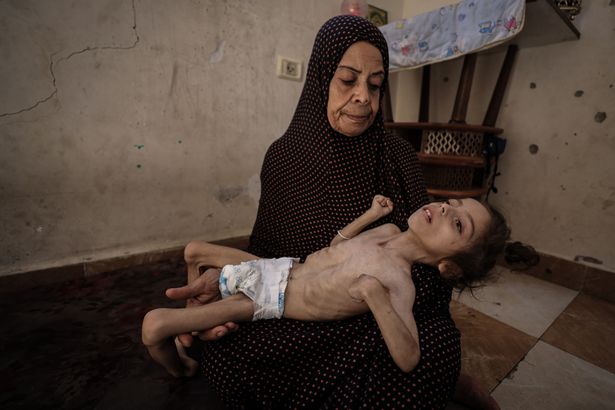   يوسك مادهون ، البالغ من العمر 6 سنوات ، والذي يزن 4 كيلوغرامات فقط ، مع كل من ضمور الدماغ وسوء التغذية الشديد الناجم عن الجوع في مدينة غزة ، غزة