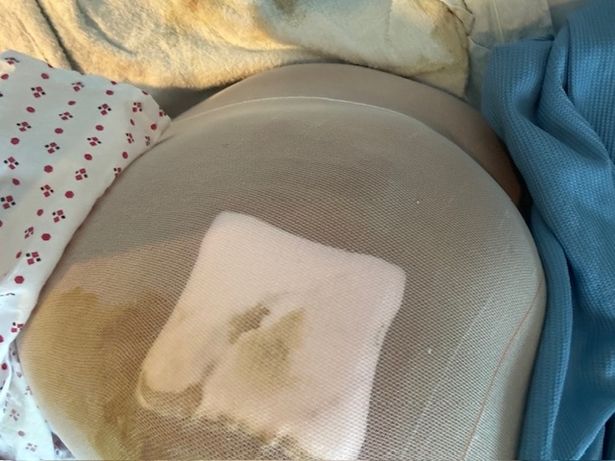 ذهبت ساشا دين في فشل متعدد الأعضاء عندما أخطأ سائل BBL 