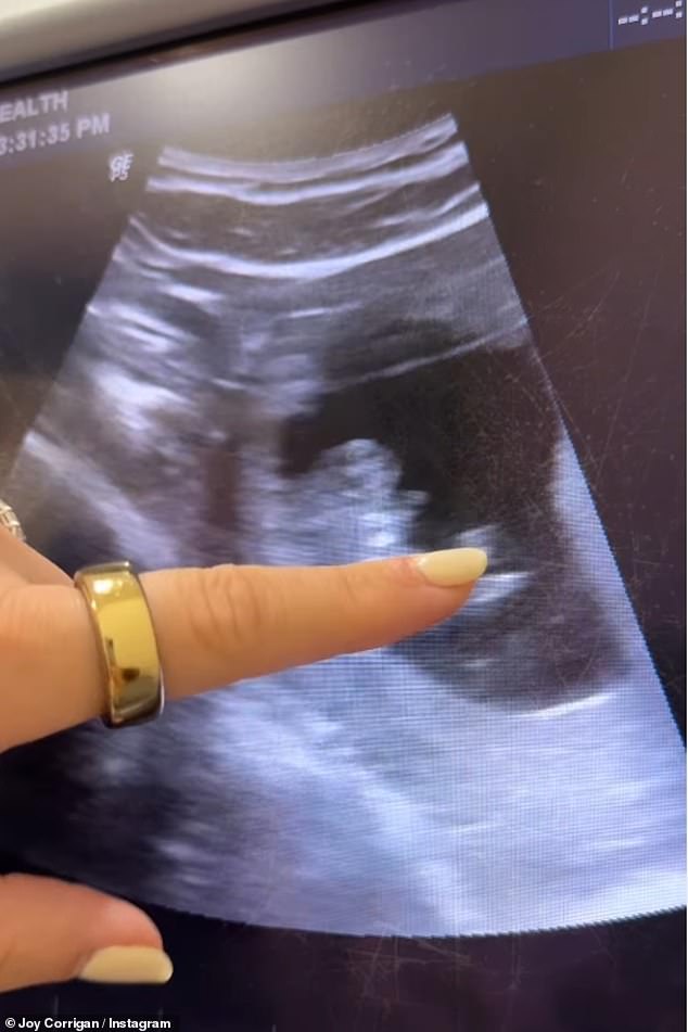 عندما أظهر فني الموجات فوق الصوتية للزوجين السعيدين المونيون ، قام تود بتشويه: 