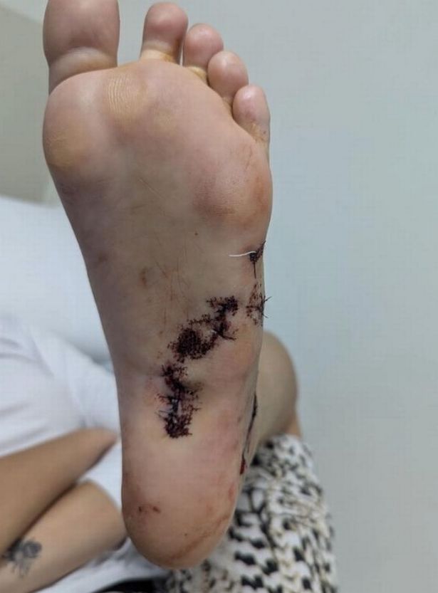 إصابة تعرضها كلوي بعد أن توقف كلب على قدمها
