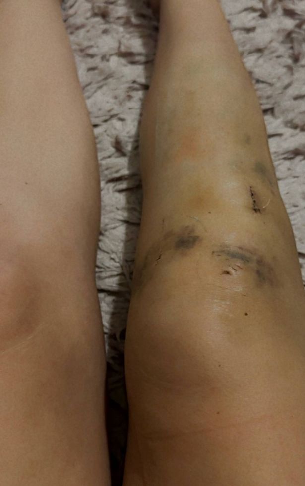 تُظهر هذه الصورة أرجل كلوي بعد عدة أسابيع من الحادث