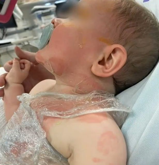 لوكا ملقاة على سرير مع بقع حمراء زاهية على جلده
