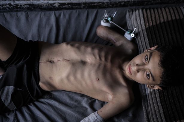 الطفل الفلسطيني البالغ من العمر 11 عامًا سمير محمد سمير زكوت يحارب من أجل الحياة