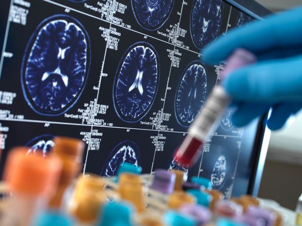 المملكة المتحدة ، أبحاث High Wycombe و Alzheimer's و Dementia ، عالم يحمل عينة من الدم أثناء تجربة سريرية مع التصوير بالرنين المغناطيسي على الشاشة