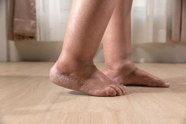 الساقين مع الوذمة
