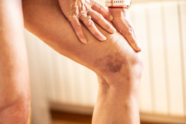 كدمة على ساق امرأة مجهولة الهوية من تشاراتشتر التخثر. جلطة دم على ساق امرأة مع الهيموفيليا