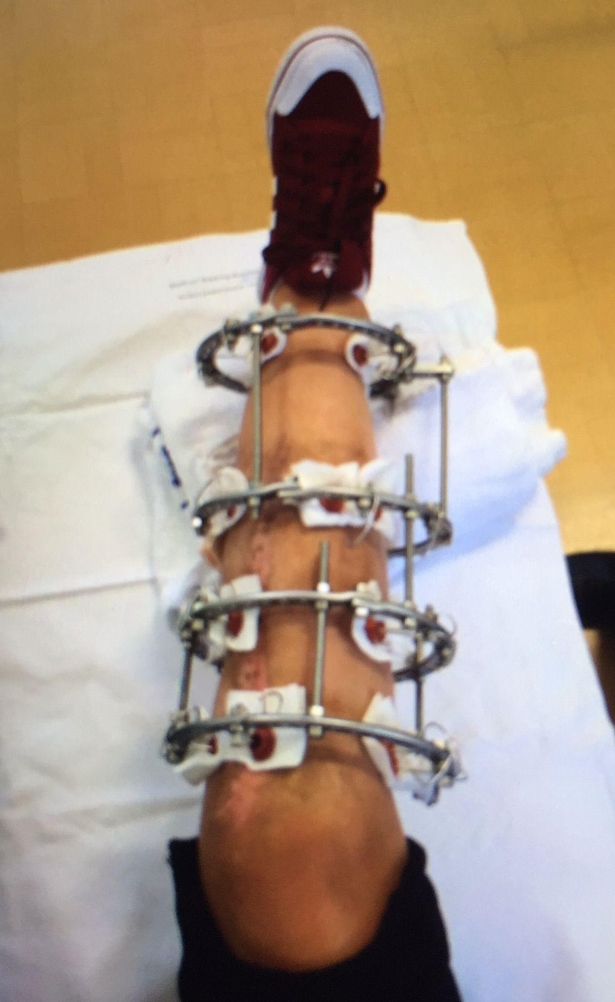 في الصورة: ساق Gracies بعد تشخيص إصابتها بساركوما خلية المغزل.