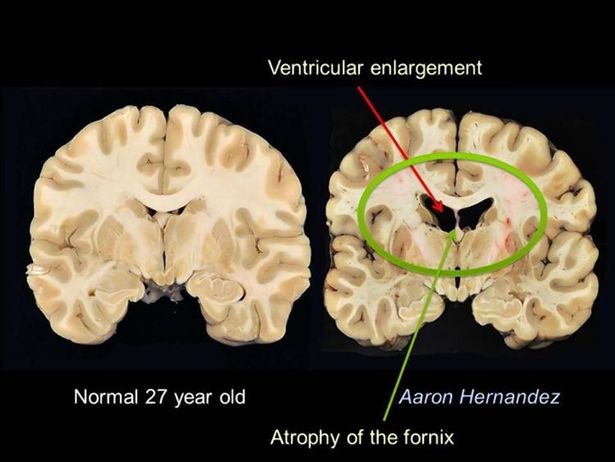 دماغ طبيعية البالغة من العمر 27 عامًا مقارنة مع عقل هرنانديز