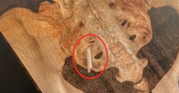 في الصورة: الأشعة السينية التي تُظهر القطعة المكسورة من مقياس الحرارة الذي تم وضعه داخل MS Hu's Bum لمدة 22 عامًا.
