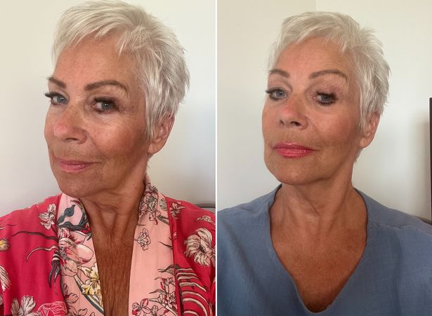 دينيس ولش قبل وبعد صور شخصية