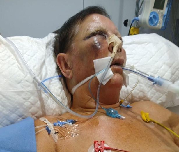 سو في سريرها في المستشفى 