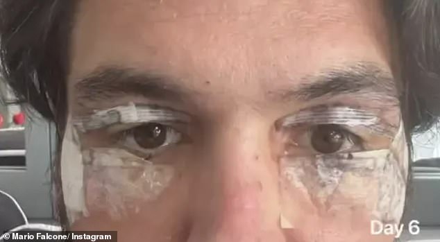 في العام الماضي، أنفق ماريو 3700 جنيه إسترليني على جراحة رأب الجفن، والتي تزيل الجلد الزائد أو الدهون من الجفون لتقليل مظهر الجفون المغطاة أو المتدلية أو أكياس العين.