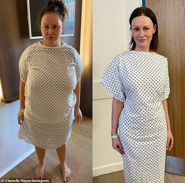 فقدت شانيل تسعة أحجار وانخفض مقاسها من 18 إلى مقاس 6، وأعلنت لاحقًا أن الجراحة 