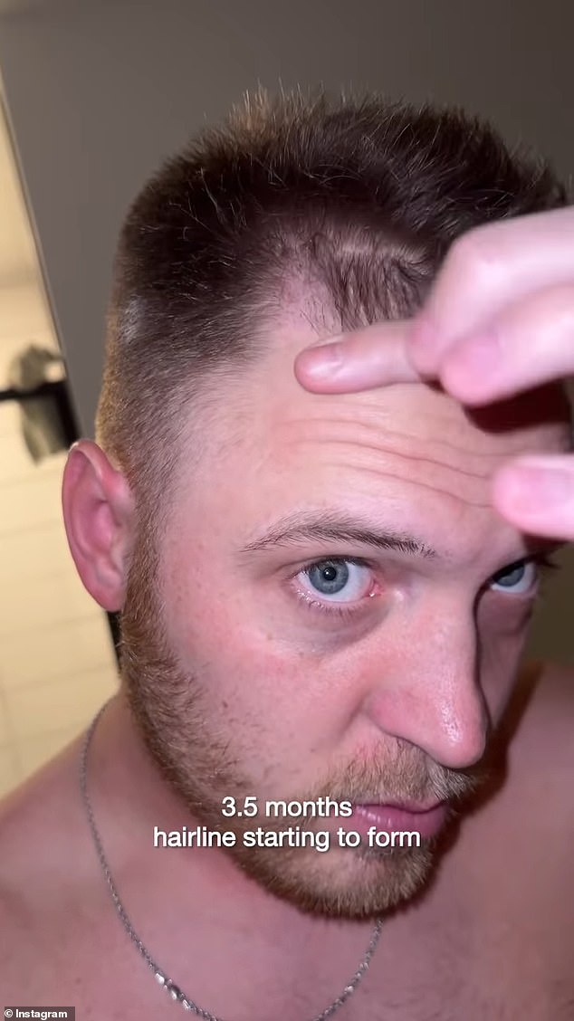 أجرى بريسنيل عملية زراعة الشعر في الولايات المتحدة بدلاً من تركيا، حيث تعد الجراحة التجميلية والبلاستيكية أرخص بكثير