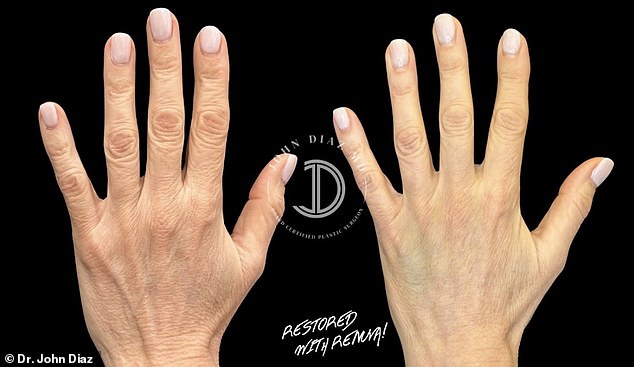 صور قبل وبعد لجراحة تجديد شباب اليد للدكتور جون دياز